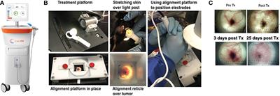 Nano-pulse stimulation™ therapy (NPS™) is superior to cryoablation in clearing murine melanoma tumors